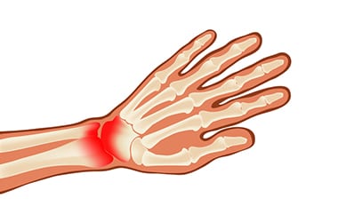 Regional Pain Thumb - Conditions
