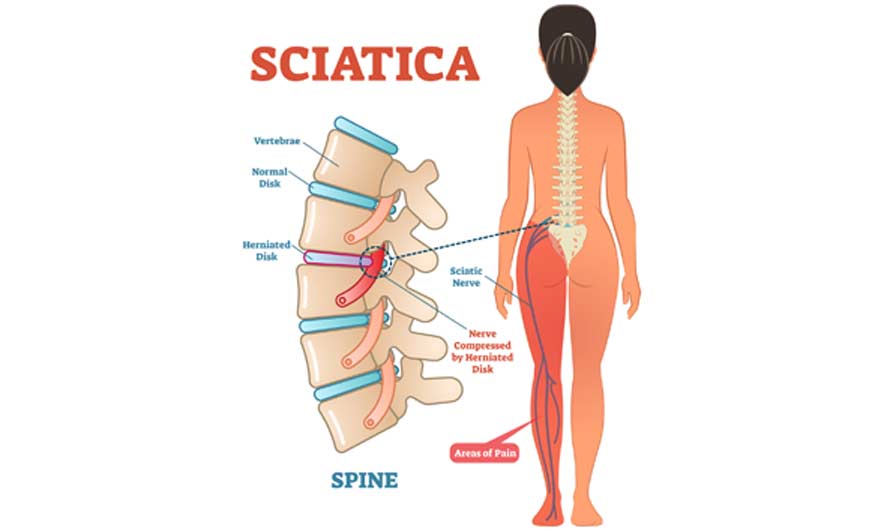 Sciatica Specialist in Los Angeles sciatica specialist in los angeles los angeles pain associates 3 - Sciatica Specialist in Los Angeles